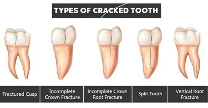 cracked tooth syndrome