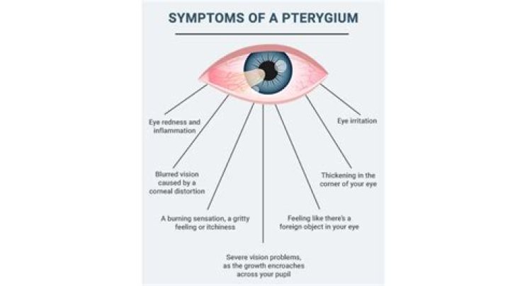 Does pterygium disappear