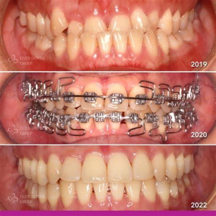 Retainer To Fix Underbite